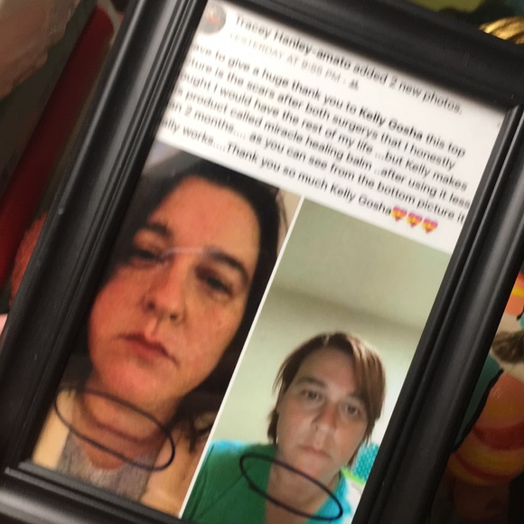 ❤️‍🩹CUSTOM w/ TEA TREE 🌳 OIL ❤️‍🩹😱 MIRACLE HEALING BALM! BEST IN BEAUTY!! - Picture 8 of 11